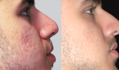 facial acne scar reduction before after oakville mississauga